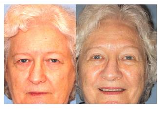 Fran Martin before and after