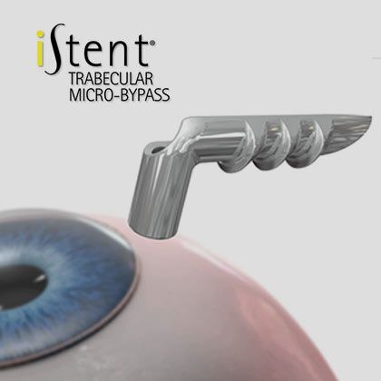 Glaucoma I-Stent