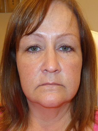 Restylane Lyft Before Photo