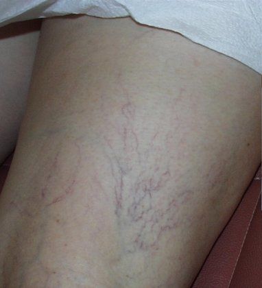 Spider veins before photo