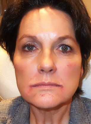 Radiesse After Photo