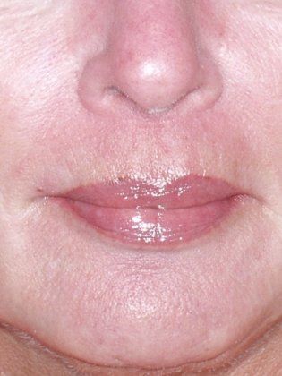 Lip After Photo